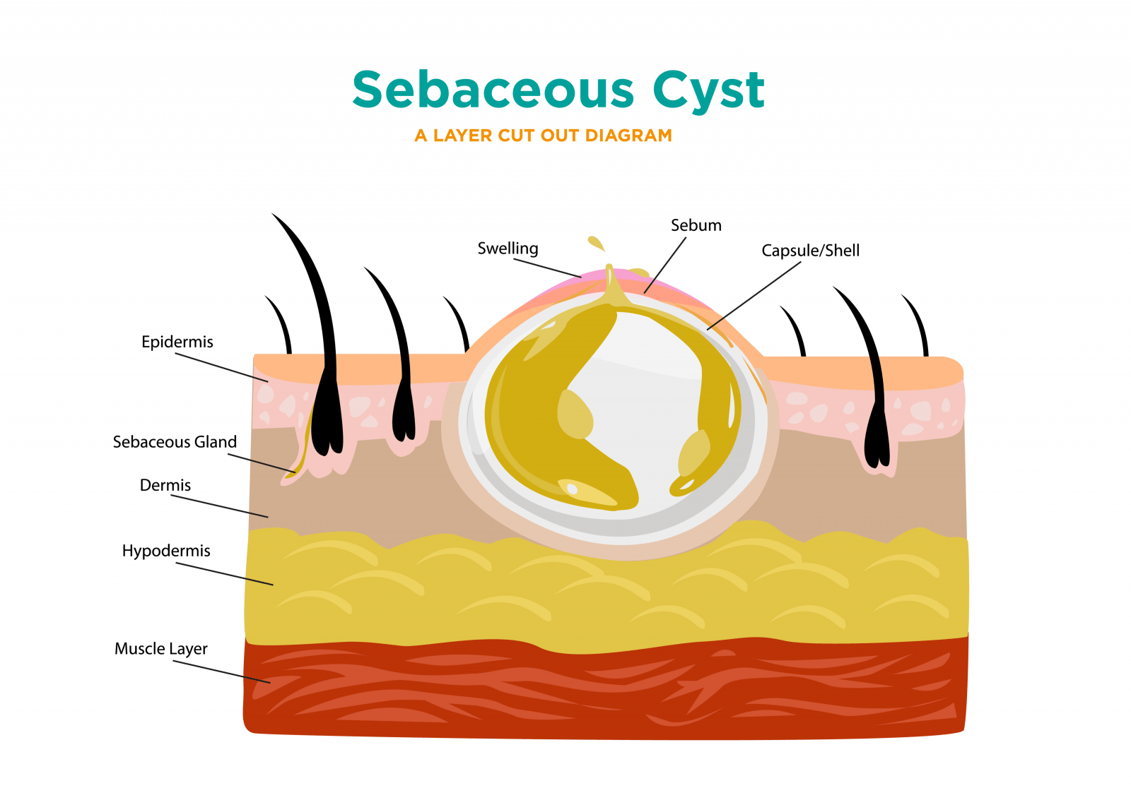 sebacous-cyst